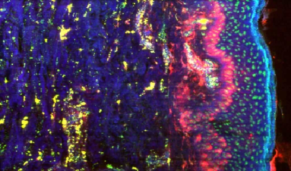 Cartographie des éléments chimiques réalisée sur une coupe histologique de peau: le phospore est bien visible dans le noyau des cellules, le fer dans les zones vascularisées (prolifération), et le potassium assez largement distribué.